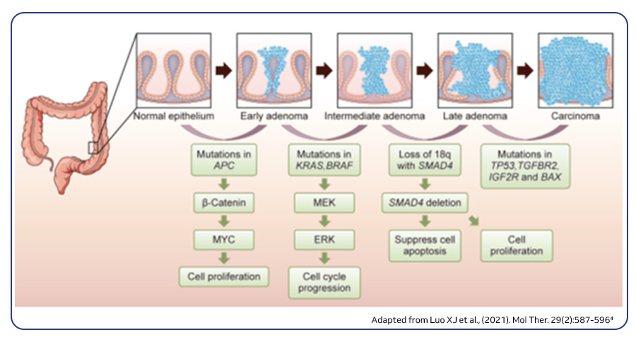 Schematic illustration of the progression model of CRC