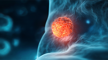 Characterizing solid tumor heterogeneity with multiomic approaches from Signios Bio
