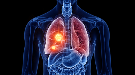Decoding lung cancer complexity with spatial transcriptomics